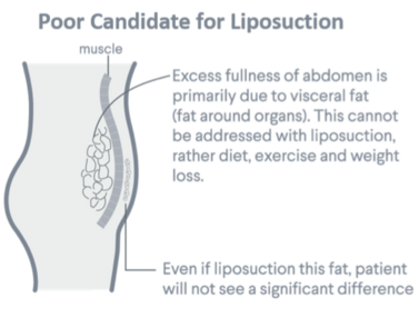 liposuction poor candidate