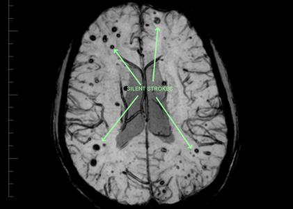 guiden Tom Audreath død Proscan Imaging Buffalo - Mri Scan Stroke, Mri Scan, Mri Brain