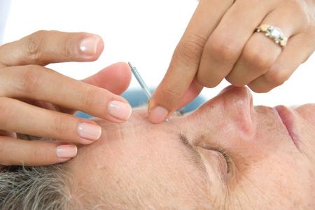 Man lying on his back while acupuncturist inserts needle into his forehead