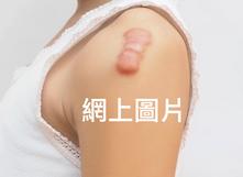 左邊膊頭突出的疤痕（疤痕增生，蟹足腫）