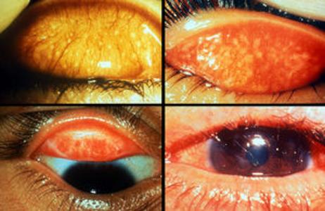 TRACHOMA – Mode of Infection, Clinical Manifestations, Classification, Diagnostic Evaluation and Medical Management