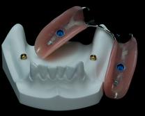 PROTHÈSE DENTAIRE AMOVIBLE SUR IMPLANTS REMOVABLE DENTURE ON IMPLANTS Brossard-Laprairie