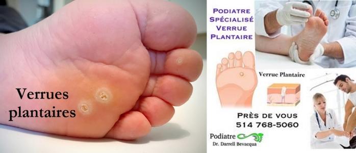 Chirurgie des verrues plantaires - Podiatres - PiedRéseau