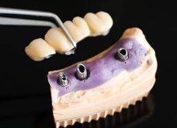 Pont dentaire sur implants dentaire Brossard-Laprairie