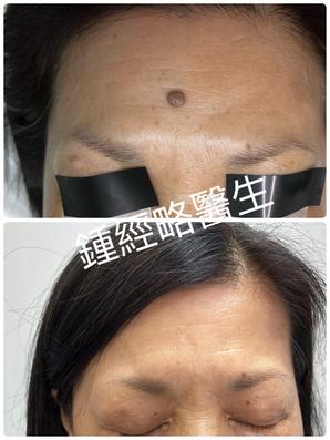 a before and after picture of removal of a brown skin nevus on forehead