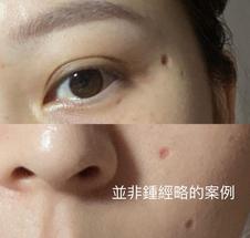 scar on face after mole removal