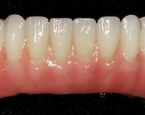 Prothèse Fixe Sur Implants Fix-On-Zircon Fixed Denture On Implants Fix-On-Zircon Brossard-Laprairie