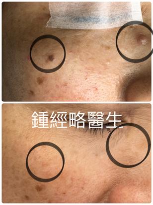 a before and after photo of removal of 2 naevi on right face with no scar seen