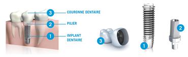 Couronne Sur Implant Clinique Implantologie Dentaire