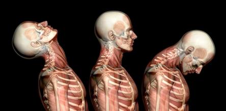 Bucks County, PA - Whiplash Injury from Auto & Car Accident - Chiropractor & Dr for Whiplash Pain Relief local near me in Bucks County, PA