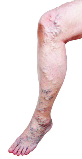 Varicose Veins Support Group: VariStop.com