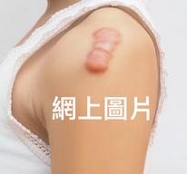 hypertrophic scar on shoulder