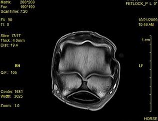 Bone stimulators - Questions and Answers ​in MRI