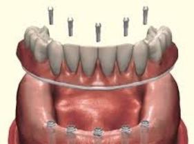Denture Fix-On-5 Clinique Implantologie Dentaire Brossard-LaPrairie