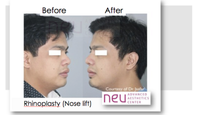 Rhinoplasty before and after photos