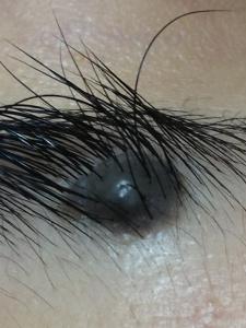 近鏡觀察一粒生長在眉毛內，深黑色的，凸出的，大墨痣