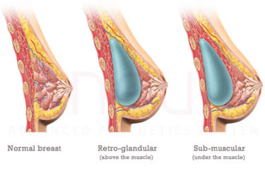 Top breast implant augmentation clinic in the Philippines NEU