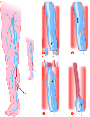 Varicose and Spider Vein Treatments – Medicalux