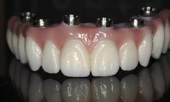 Prothèse Fixe Fix-On-Zircon Fixed Denture Fix-On-Zircon Brossard-Laprairie