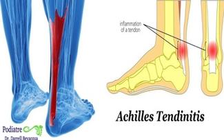 How Do Heel Spurs Develop?: InStride Queen City Foot and Ankle Specialists:  Podiatrists