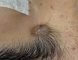 a big brown hairy oval shaped mole located under the medial end of the left eyebrow