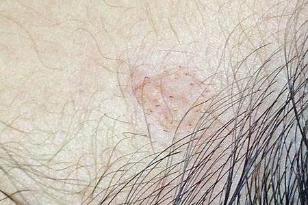 After laser mole removal on the neck, the wound is barely noticeable.