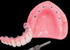 Fixed Denture On Implants Brossard-Laprairie