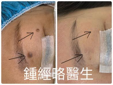 2 skin moles locates on the left upper eyelid