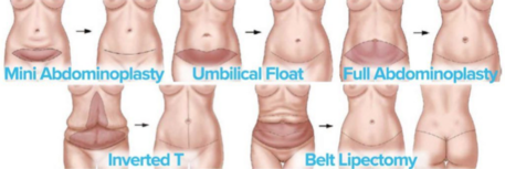 Tiny Tuck: Floating the Belly Button: Advanced Techniques – Dr