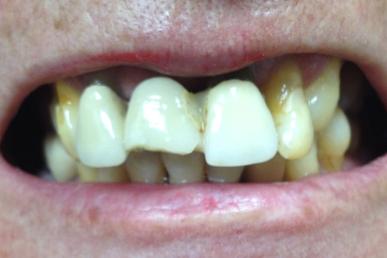 Patient Michel Puertas Denturologiste Brossard-Laprairie