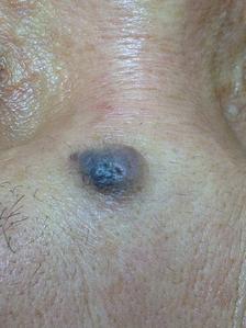 a dark grey skin mole on the glabella area (between eyebrow)