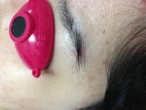 as the scar hides inside the eyebrow, scar is not visible after suture removal