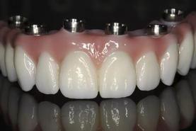 Prothèse Dentaire Fixe Zircon Sur Implants Michel Puertas Denturologiste Brossard-Laprairie, Fixed Denture On Implants Michel Puertas Denturologiste Brossard-Laprairie