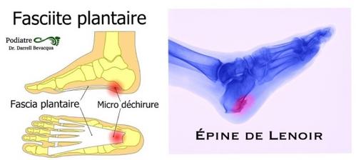 Fasciite plantaire pine de Lenoir. Solutions sans douleur