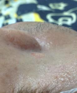 近鏡水平觀察激光脫墨後的傷口情況：傷口沒有流血，墨痣的根部已經被除去，傷口很淺，沒有疤痕