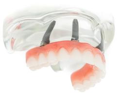 Denture On Implants Fix-On-4 Clinique Implantologie Dentaire