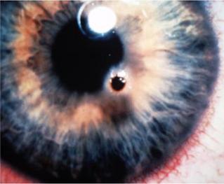 foreign body in eye