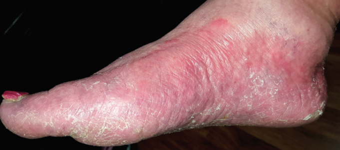 COMMON FUNGAL INFECTIONS – Tinea Pedis – Causes, Signs and Symptoms, Diagnostic Evaluations and Management