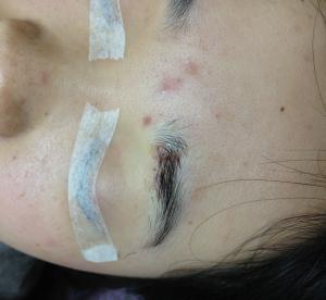 appearance of a sutured skin wound near eyebrow after skin mole excision