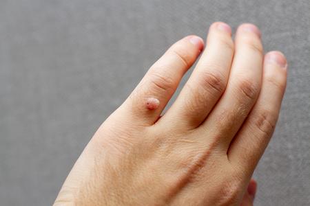 COMMON VIRAL INFECTIONS – Warts - TYPES, Clinical Manifestations, Treatment and Prevention