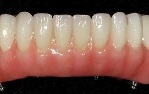 Fixed Denture On Implants Michel Puertas Denturologiste Brossard-Laprairie