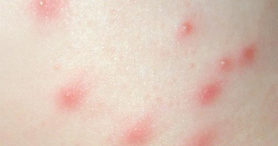 FOLLICULITIS – Causes, Risk Factors, Types, Clinical Manifestations, Treatment