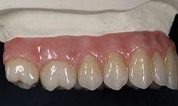 Prothèse Fixe Fix-On-Zircon Fixed Denture Fix-On-Zircon Brossard-Laprairie