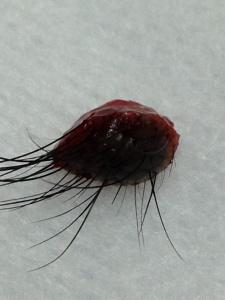 另一個角度近鏡觀察一粒已經被切了出來的，巨大的，有毛長出來的黑色的墨痣