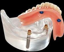 Denture On Implants Clinique Implantologie Dentaire