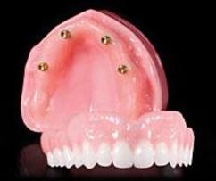 Denture On Implants Michel Puertas Denturologiste Brossard-Laprairie