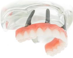 Denture Fix-On-4 Clinique Implantologie Dentaire Brossard-LaPrairie