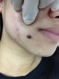 一粒位於下巴右邊的深啡色的凸出的，表面平滑的墨痣