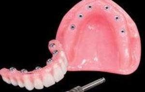 Fixed Denture On Implants Michel Puertas Denturologiste Brossard-Laprairie