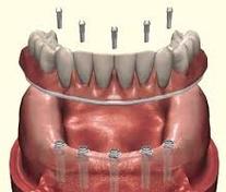 Prothèse Dentaire Sur Implants Fixe Fix-On-5 Brossard-Laprairie